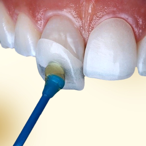 تجميل الابتسامة / الفينيرز